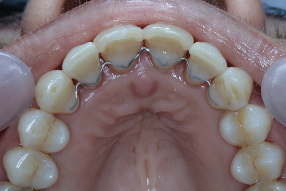 Zähne vorstehende Endotracheale Intubation,