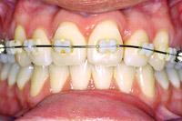 brackets2.jpg