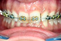 brackets3.jpg